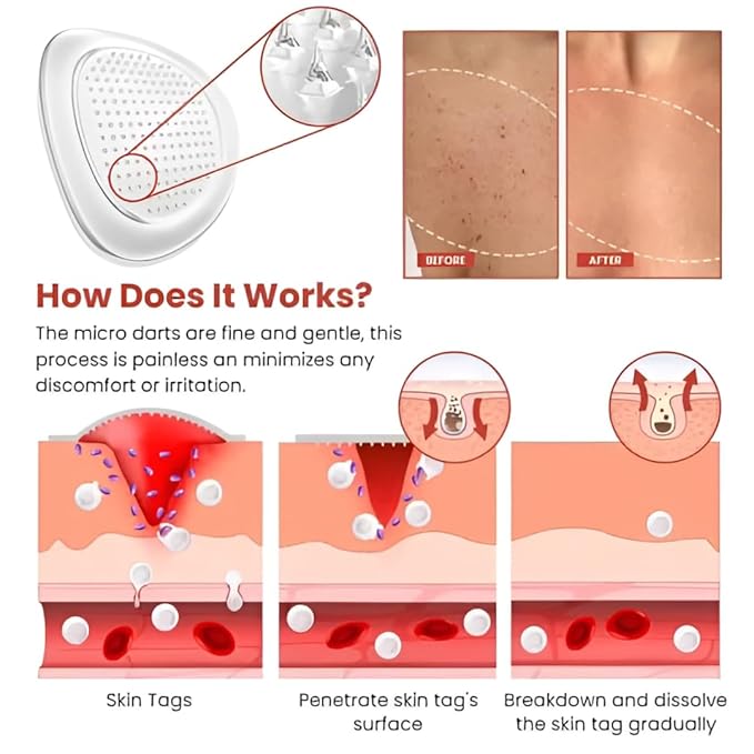 Derma Smooth Skin Tag Removal Patch – Painless, Natural Formula